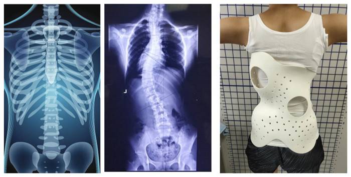 3d-printed Scoliosis Orthoses